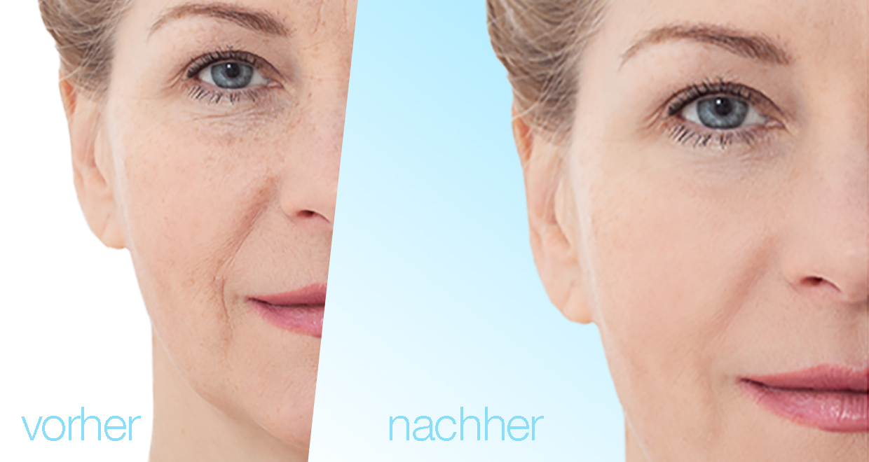 microneedling vorhernachher